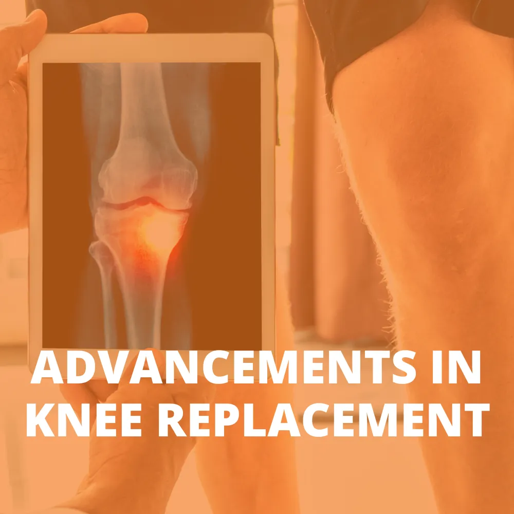 Advancements in knee replacements